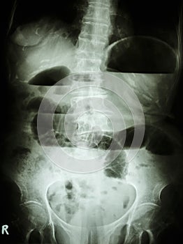 Small bowel obstruction