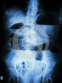 Small bowel obstruction