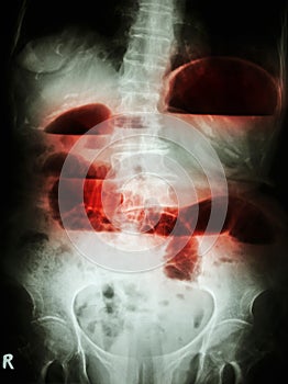 Small bowel obstruction