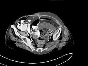 Small bowel obstruction - CT scan of the abdomen