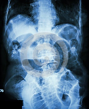 Small bowel obstruction. Film X-ray abdomen supine