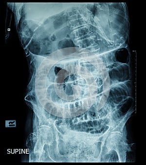 Small bowel obstruction ( film x-ray abdomen ( supine position ) : show small bowel and stomach dilate ) ( step ladder pattern )