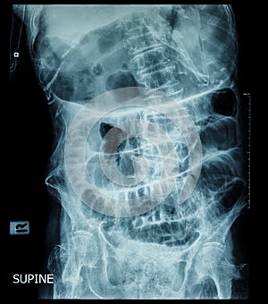 Small bowel obstruction ( film x-ray abdomen ( supine position ) : show small bowel and stomach dilate ) ( step ladder pattern ) photo