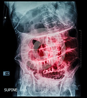 Small bowel obstruction ( film x-ray abdomen ( supine position ) : show small bowel and stomach dilate ) ( step ladder pattern )