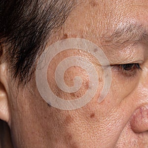 Small brown patches called age spots on face of Asian elder man. They are also called liver spots, senile lentigo, or sun spots photo