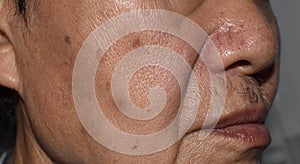 Small brown patches called age spots on face of Asian elder man. They are also called liver spots, senile lentigo, or sun spots photo
