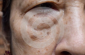 Small brown patches called age spots on face of Asian elder woman. They are also called liver spots, senile lentigo, or sun spots