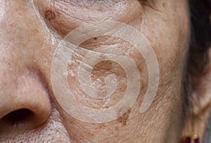 Small brown patches called age spots on face of Asian elder woman. They are also called liver spots, senile lentigo, or sun spots