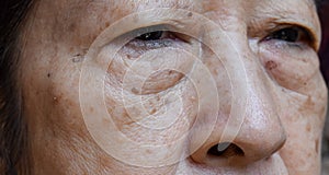 Small brown patches called age spots on face of Asian elder woman. They are also called liver spots, senile lentigo, or sun spots