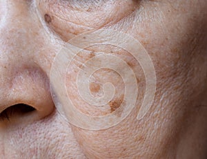 Small brown patches called age spots on face of Asian elder woman. They are also called liver spots, senile lentigo, or sun spots