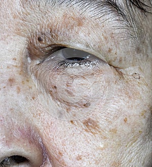 Small brown patches called age spots on face of Asian elder woman. They are also called liver spots, senile lentigo, or sun spots