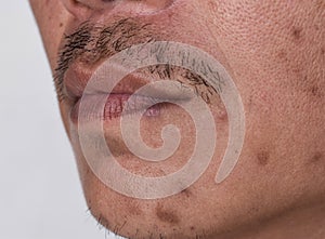Small patches called age spots and scars on the face of Asian man. Liver spots, senile lentigo, or sun spots photo