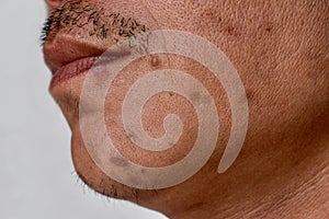 Small brown patches called age spots and scars on the face of Asian man. Liver spots, senile lentigo, or sun spots photo
