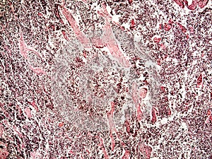 Small-cell lung cancer of a human