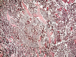 Small-cell lung cancer of a human photo