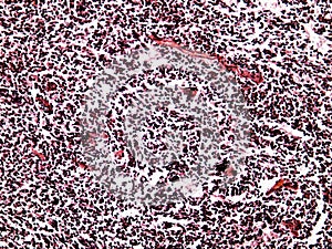 Small-cell lung cancer of a human