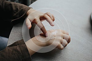 A small child smears redness on the hand with baby cream. The concept of treatment and skin care with cream, frostbite