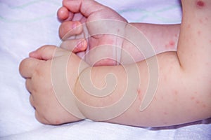 A small hand of child covered by eczema. allergy baby skin dermatitis food. dermatitis symptom problem rash. face sleeping newborn photo