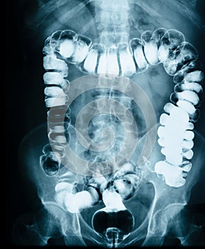 Small intestine obstruction Film X-ray