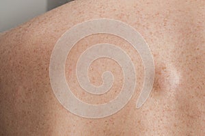 Small lipoma on the back of caucasian man photo