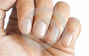 Small lunulae or half-moons at fingernails with longitudinal lines of Southeast Asian, Chinese young man