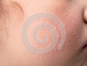 Small Milia (milk spots) are white cysts on 8 year old girl child cheek skin.