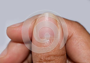 Small or missing lunula or half-moons at fingernail with longitudinal lines photo