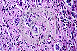 Small nodular cirrhosis, light micrograph