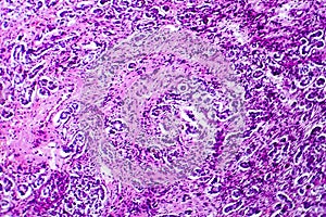 Small nodular cirrhosis, light micrograph photo