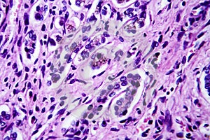 Small nodular cirrhosis, light micrograph photo