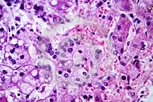 Small nodular cirrhosis, light micrograph photo