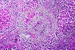 Small nodular cirrhosis, light micrograph photo