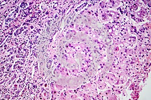 Small nodular cirrhosis, light micrograph photo