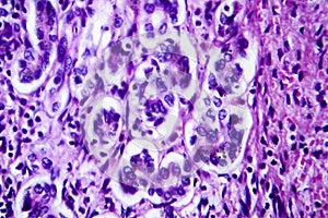 Small nodular cirrhosis, light micrograph photo