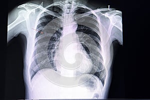 small nodule in the lung