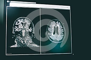 Small vessel disease and dementia on film MRI