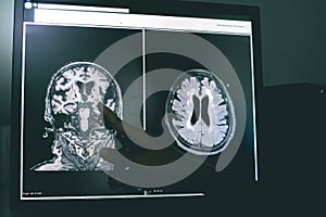 Small vessel disease and dementia on film MRI photo