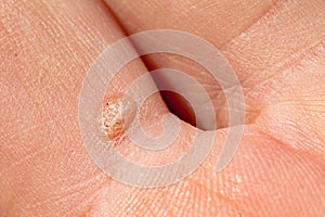 Small wart on inside of caucasian human hand