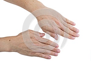 Small white and brown spots on the skin of senior man hands and arms