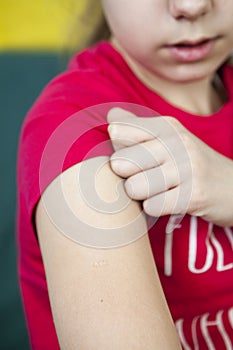 Smallpox is on human shoulder following BCG vaccination against TB vaccine photo