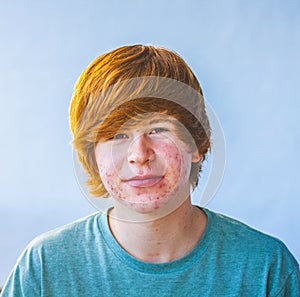 Smart boy in puberty with acne