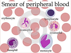 Smear of peripheral blood