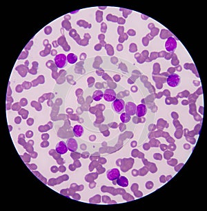 The smear shows large number of cancer leukemia cel