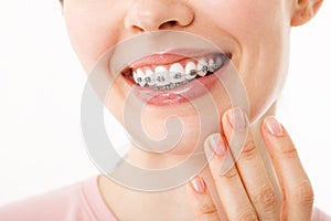 Smile with Braces Orthodontic Treatment. Dental Care Concept. Beautiful Woman Healthy Smile close up. Closeup Ceramic