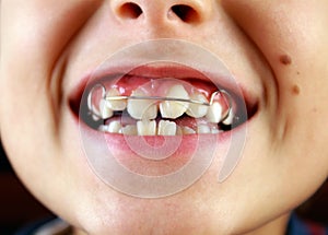Úsměv s rovnátkama na zuby 