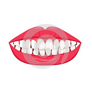 Smile with crooked teeth. White misaligned teeth with orthodontic bruxism