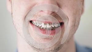 Smile with dental bracket, Man with stubble on the face smiling perfect teeth braces close up, orthodontic, dental care