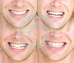 Smile Face Man with natural White Teeth Collage Dental Health photo