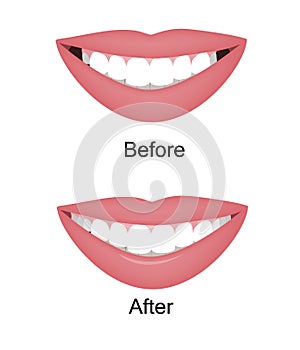 The smile with large and dark buccal corridor before and after correction. Vector illustration. Dark spaces at the edge photo