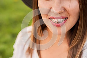 Smile not ashamed of braces, smile of a girl close-up, self-ligating braces